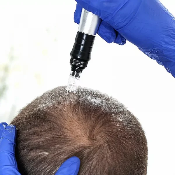 microagulhamento-capilar